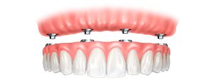  Das ALL-ON-4® Konzept bietet Zahnersatz an einem Tag für den zahnlosen Kiefer