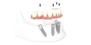 Ablauf All-on-4®: Vier Implantate halten den neuen Zahnersatz sicher